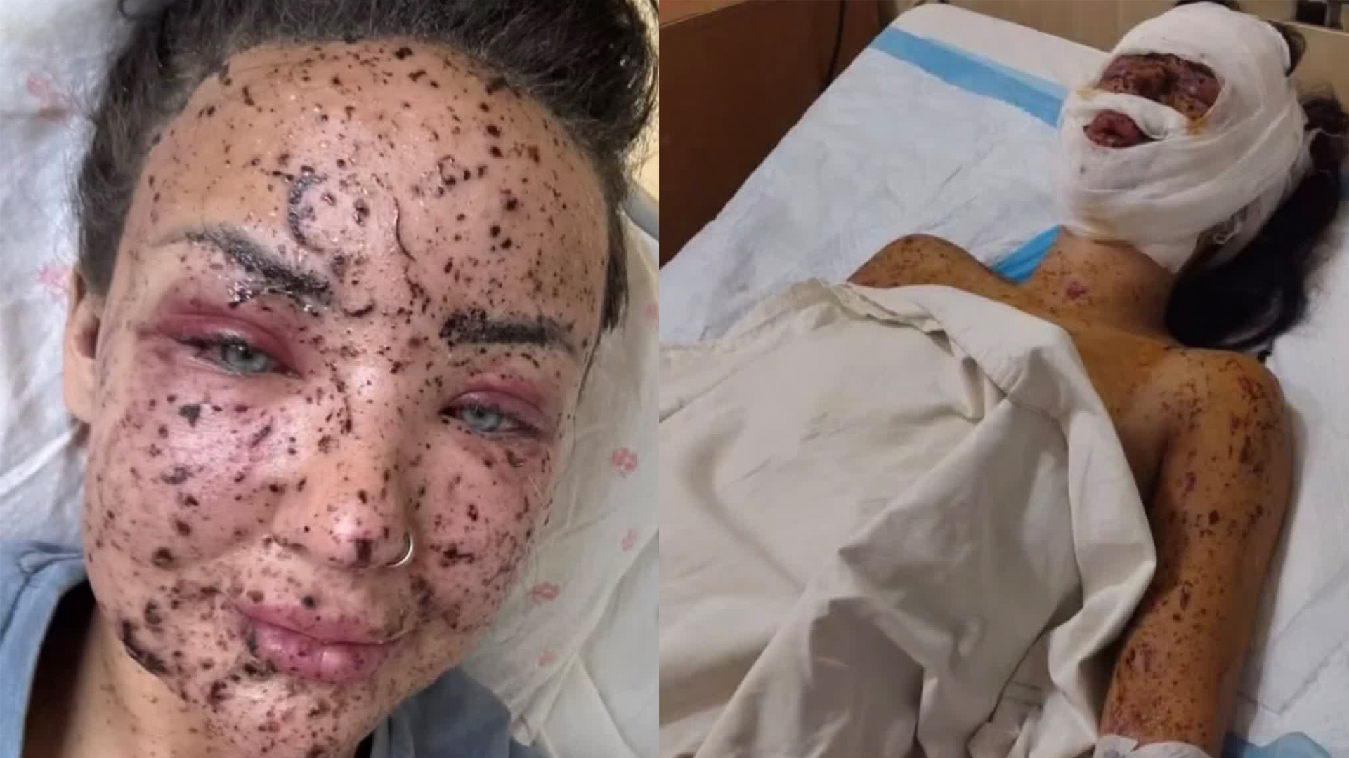 Yana was treated in hospital with multiple shrapnel injuries following the drone attack (Picture: @Multiiikk)