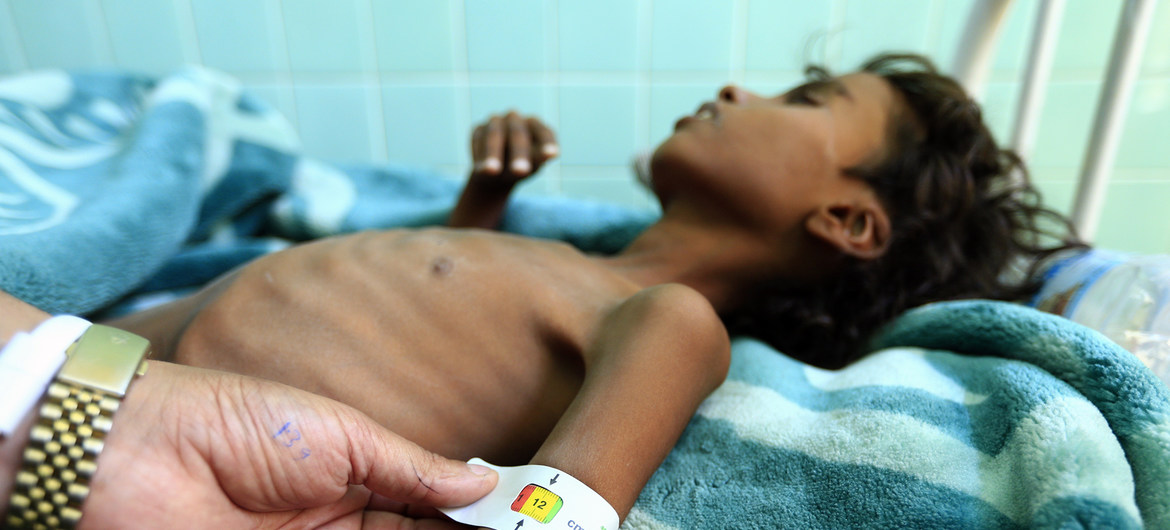 A doctor mesures the arm of 12-year-old Yemeni who is suffering from malnutrition at a treatment centre in a hospital in Sanaa in November 2018 110519 CREDIT UNICEF Huwais.jpg