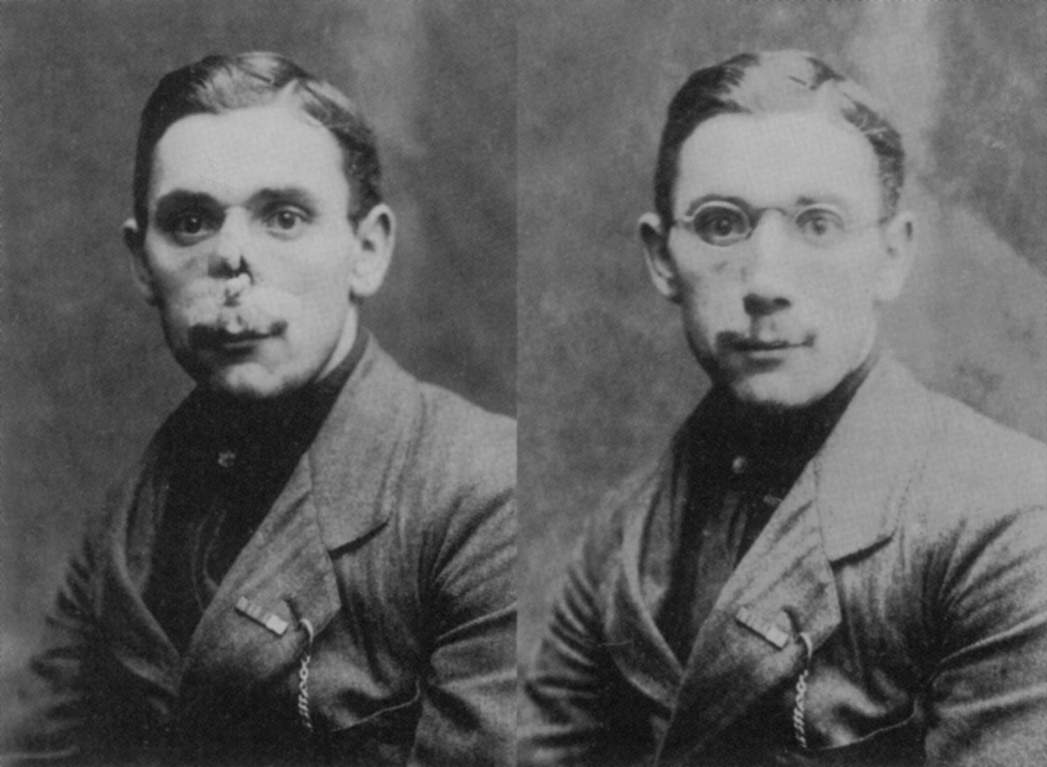 A before and after photograph of a French soldier with severe facial injuries. The mask he wears was made by American sculptor Anna Coleman Ladd (Picture: Science History Images / Alamy Stock Photo)