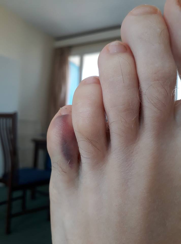 broken toe