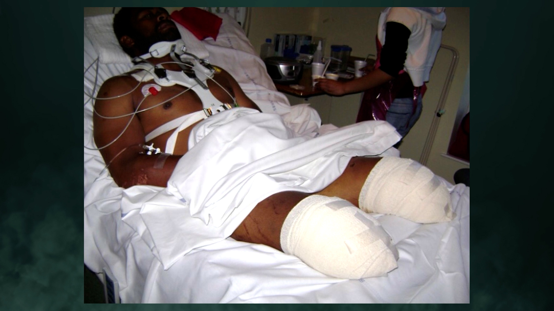 Derek lost both of his legs after the IED blast.