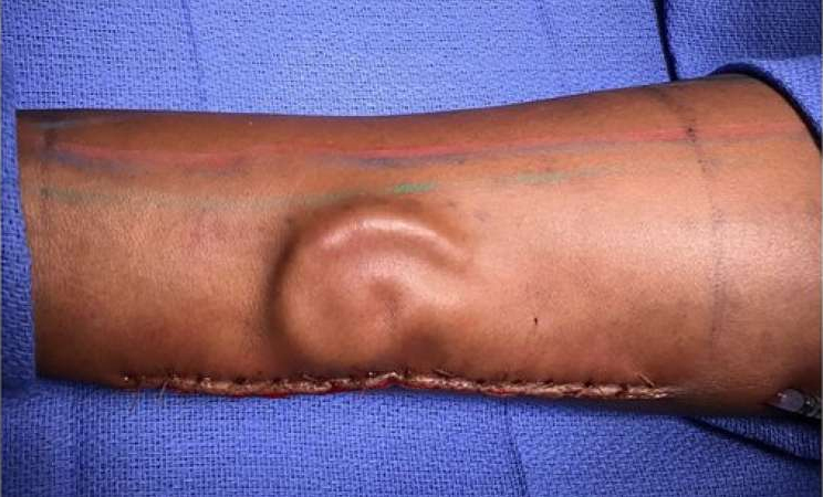 Cartilage growing in a patient’s forearm as part of a total ear reconstruction performed at William Beaumont Army Medical Center. (Credit: U.S. Army)