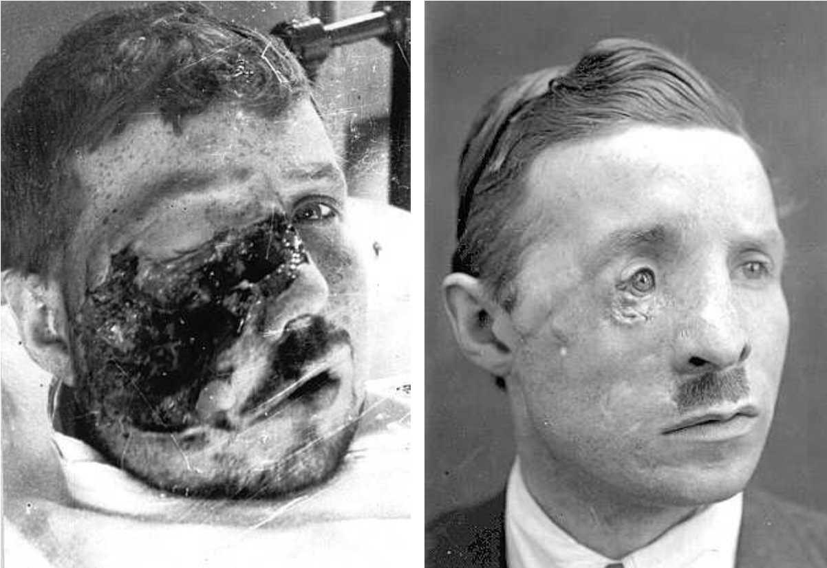 Men with broken faces first world war
