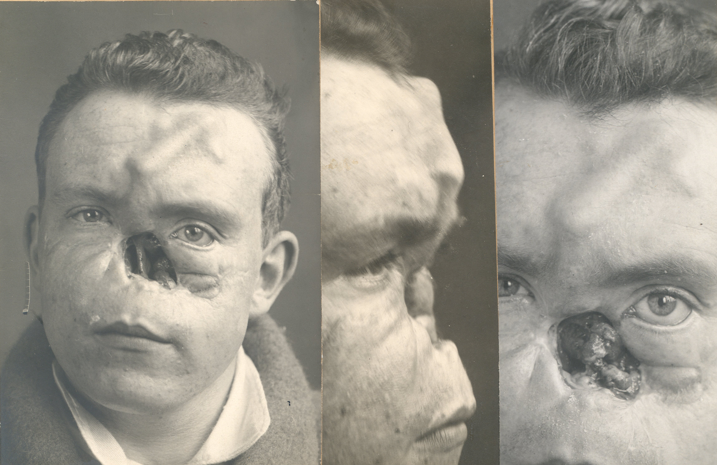 Men with broken faces first world war