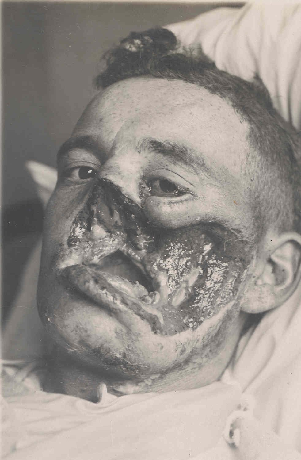 facial injury world war 1