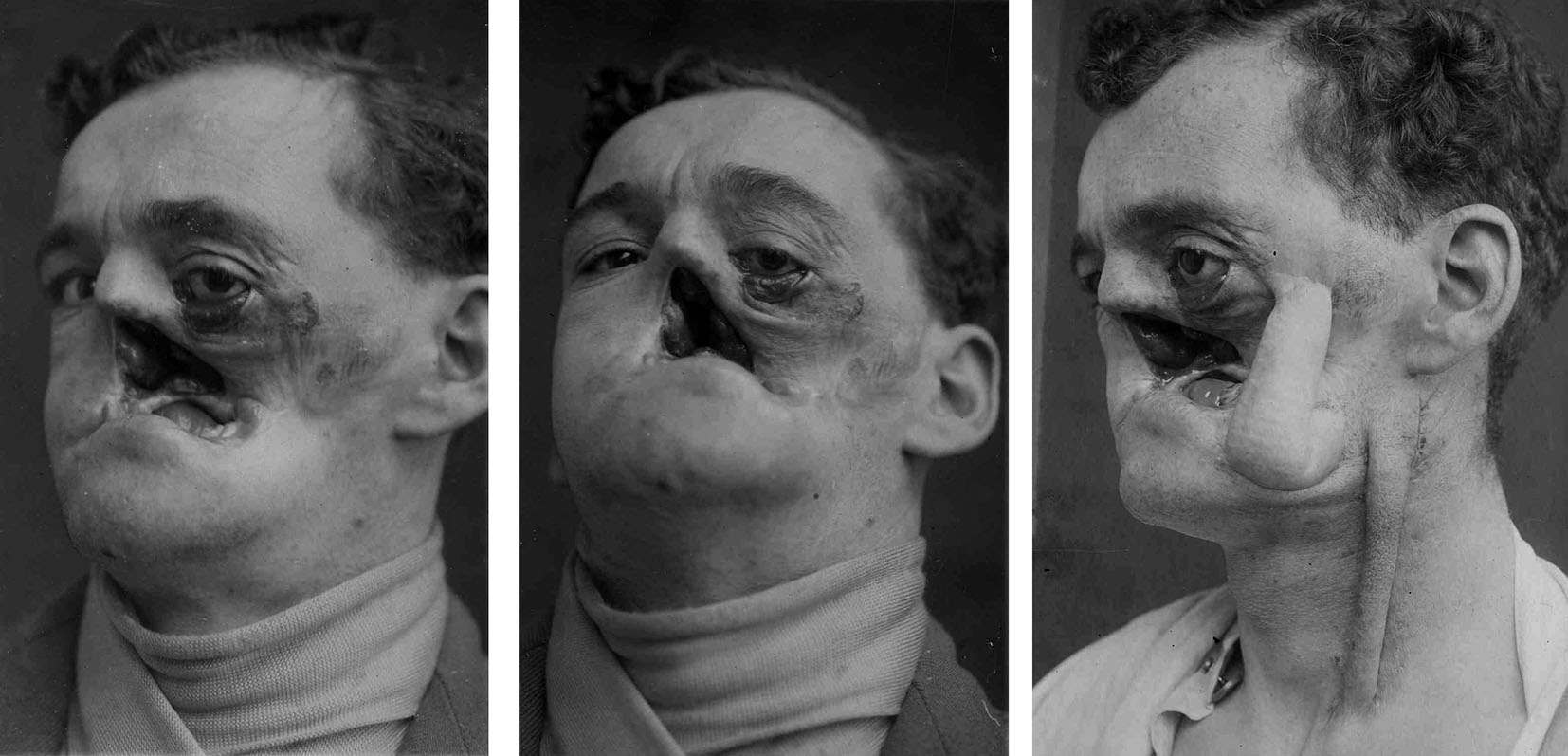 Men with broken faces
