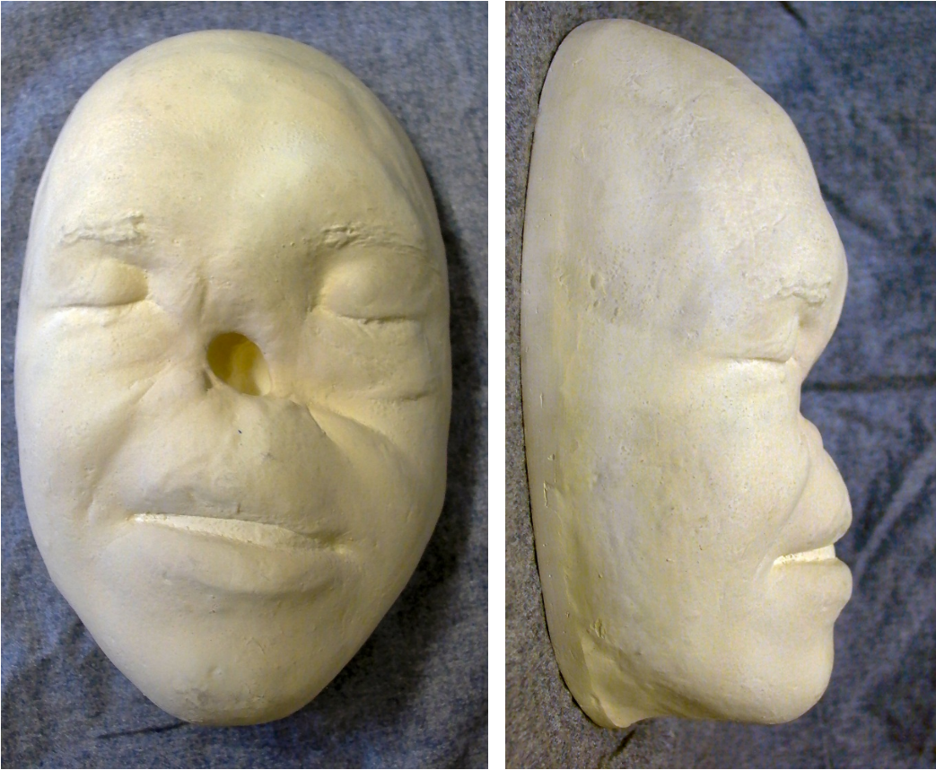 Facial injury plaster cast