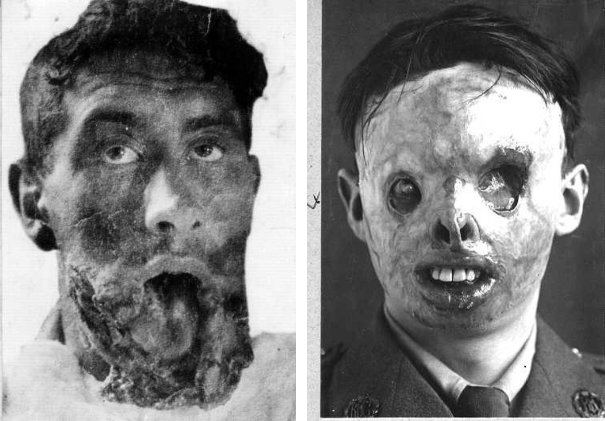 Facial injury tongue RFC burn victim first world war