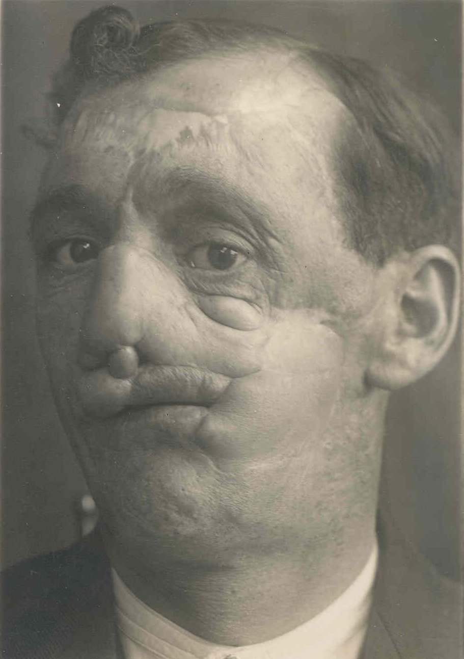 men with broken faces first world war