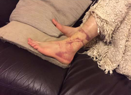 bruised ankle