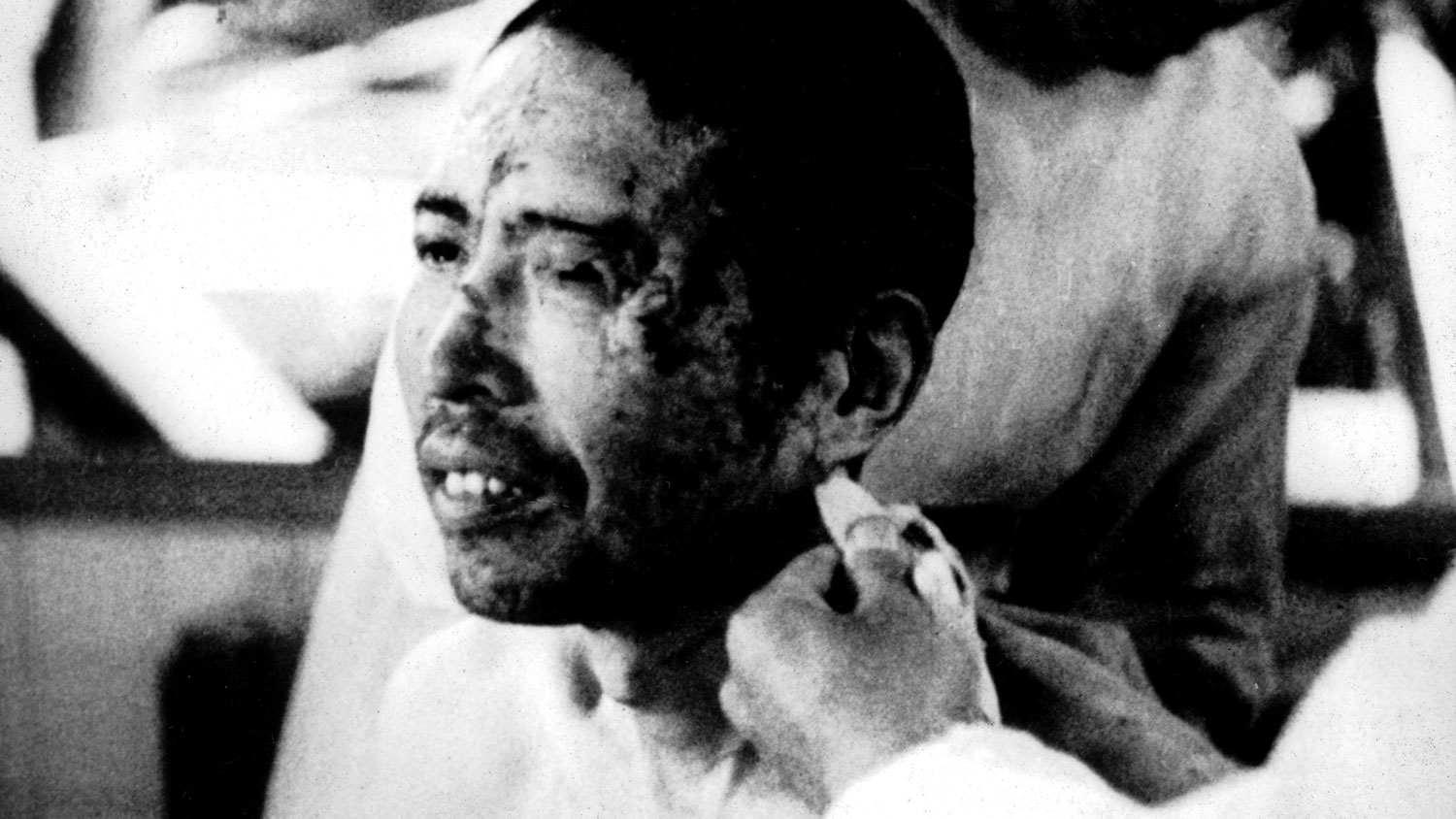 Image ID GG2DPP A victim of the atomic bomb dropped on Hiroshima World War II National archives, Washington CREDIT Photo 12 Alamy Stock Photo EXP 041123