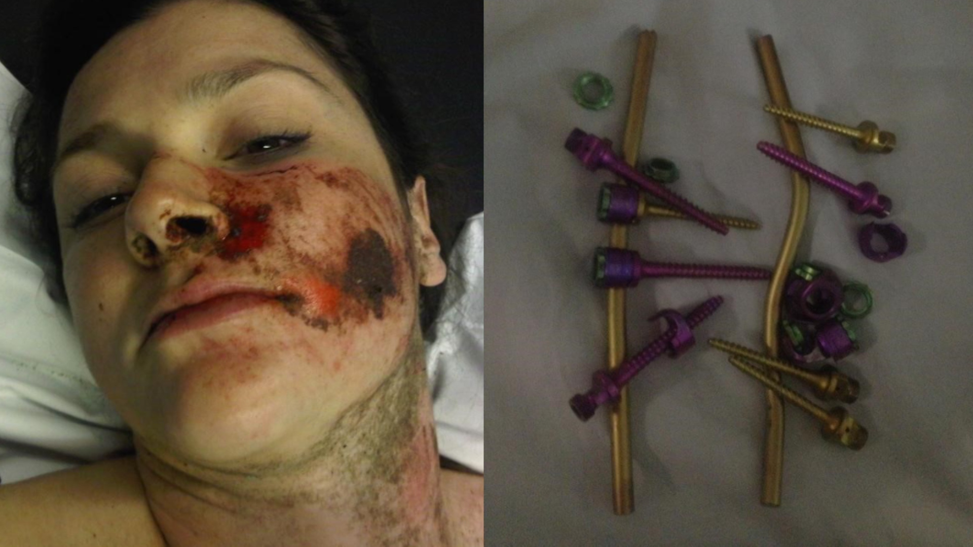 Jane McGill Broke Back Accident