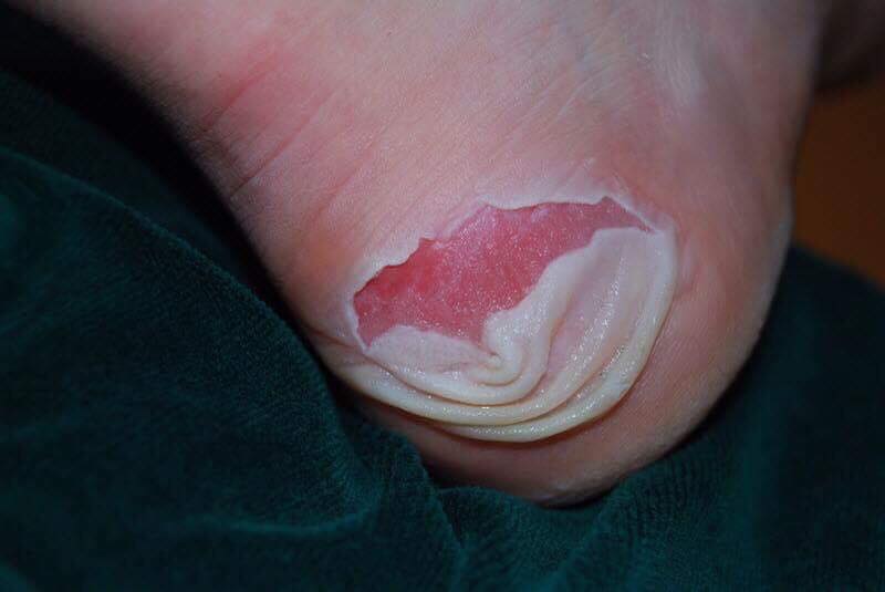 Blister foot