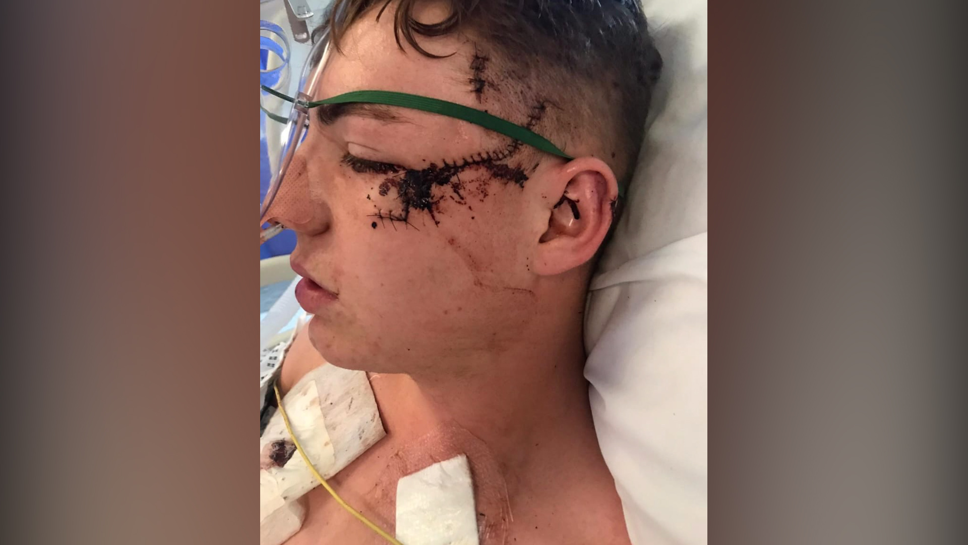 Kyle Shaw-Tullin injuries CREDIT Kyle Shaw-Tullin DATE 2019.jpg