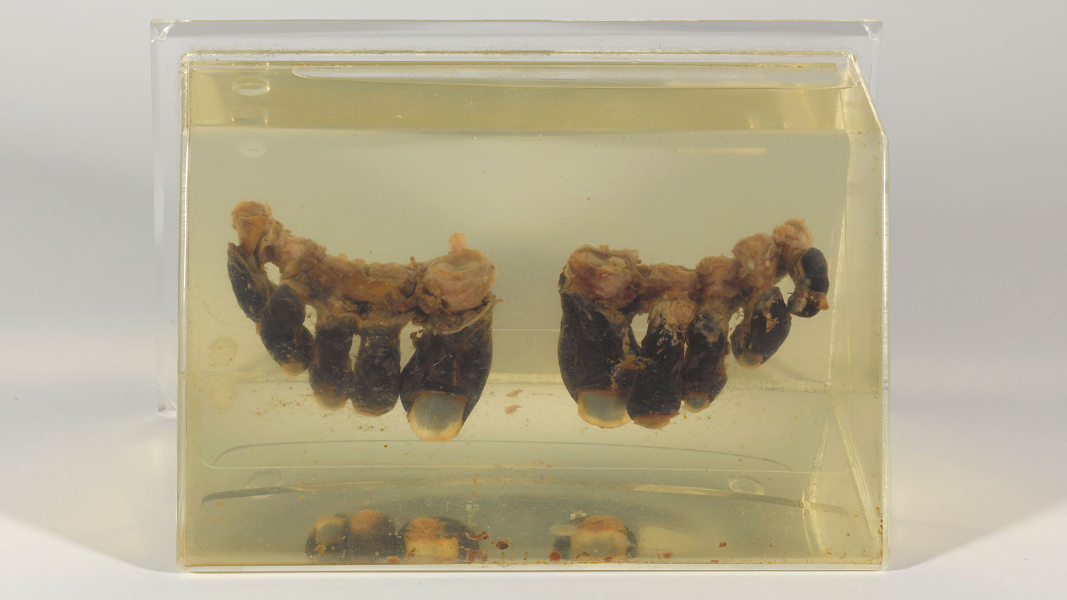 Michael Bronco Lane's frostbitten toes on display at the National Army Museum CREDIT National Army Museum copyright