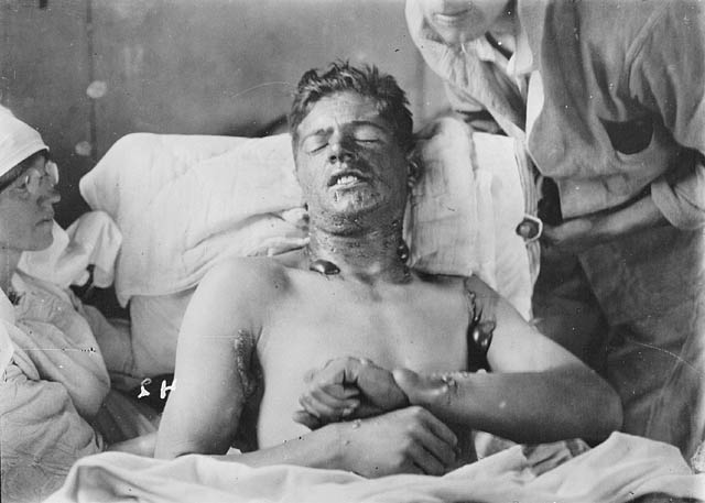 Mustard Gas