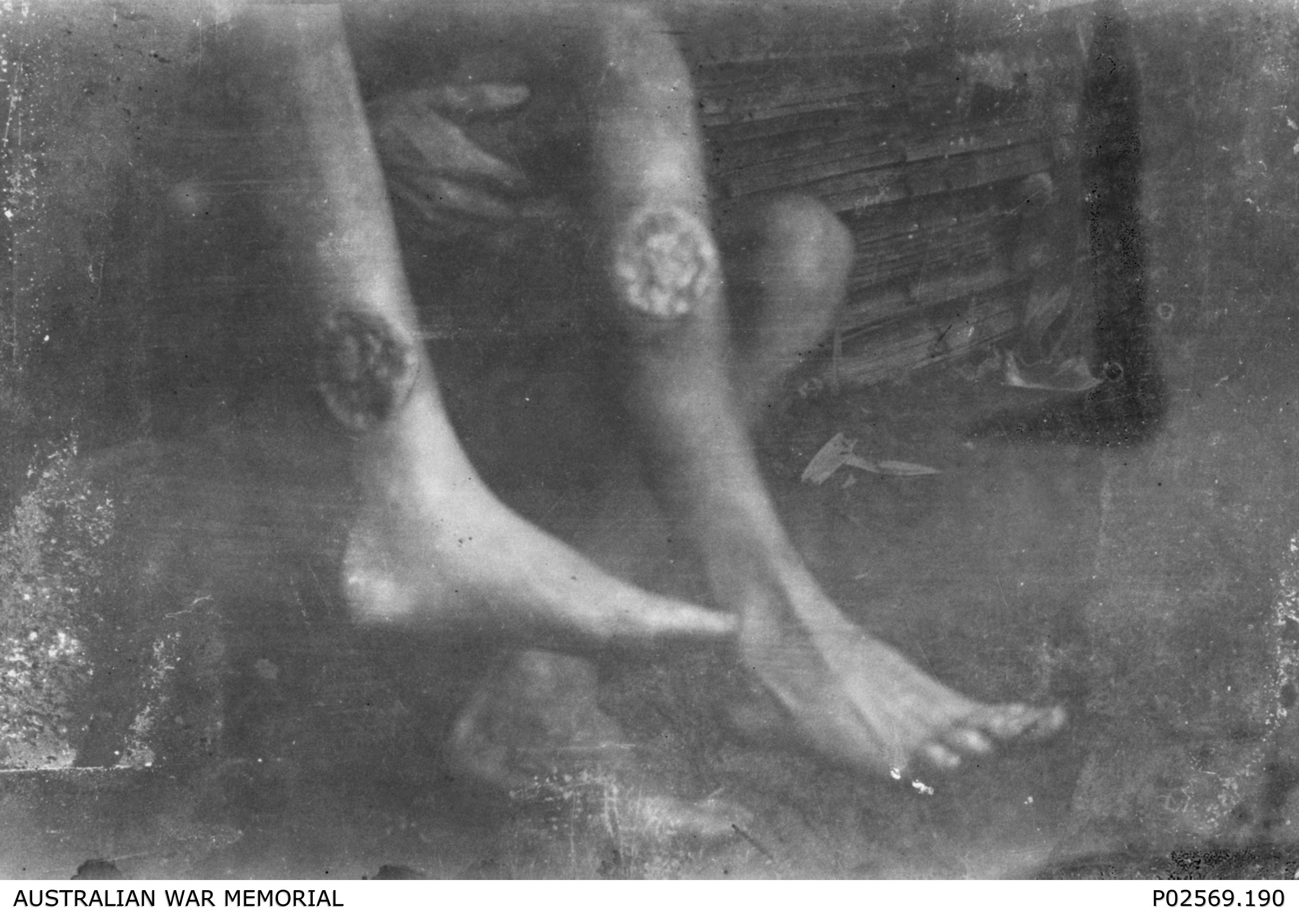 Tropical ulcers POW Burma Railway