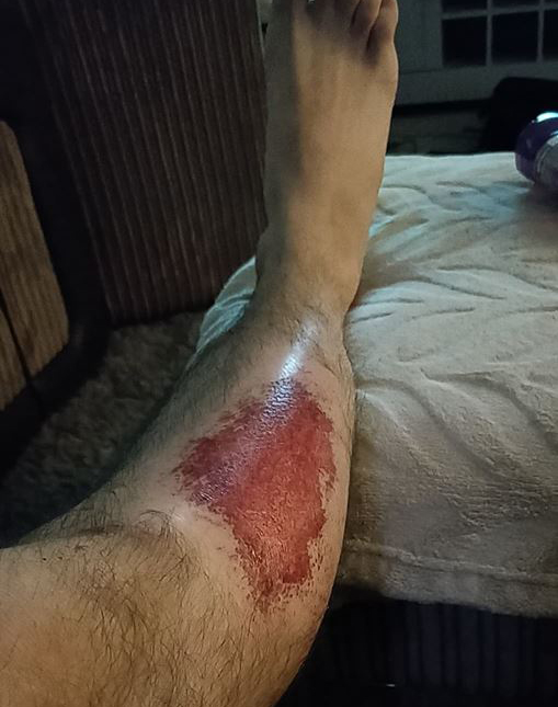 Football injury