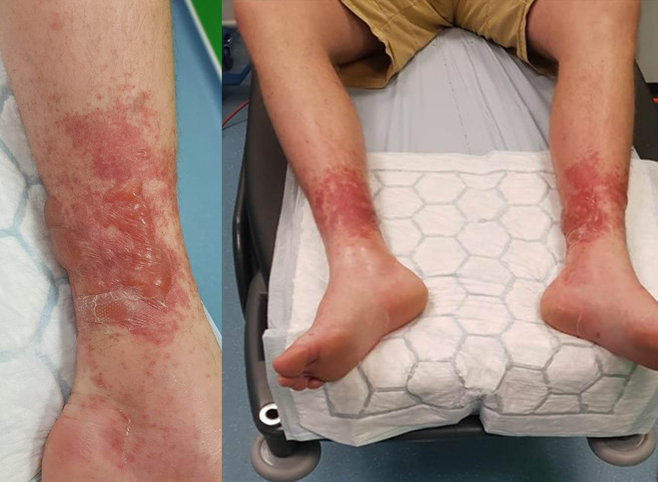 Blistered legs