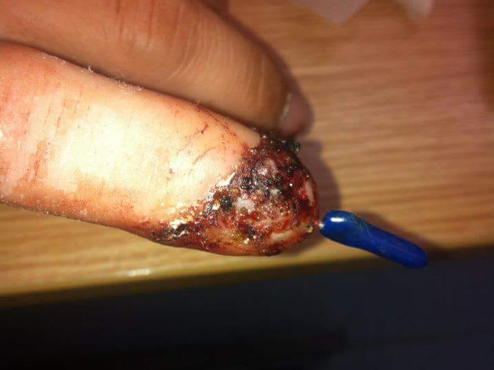 injured finger