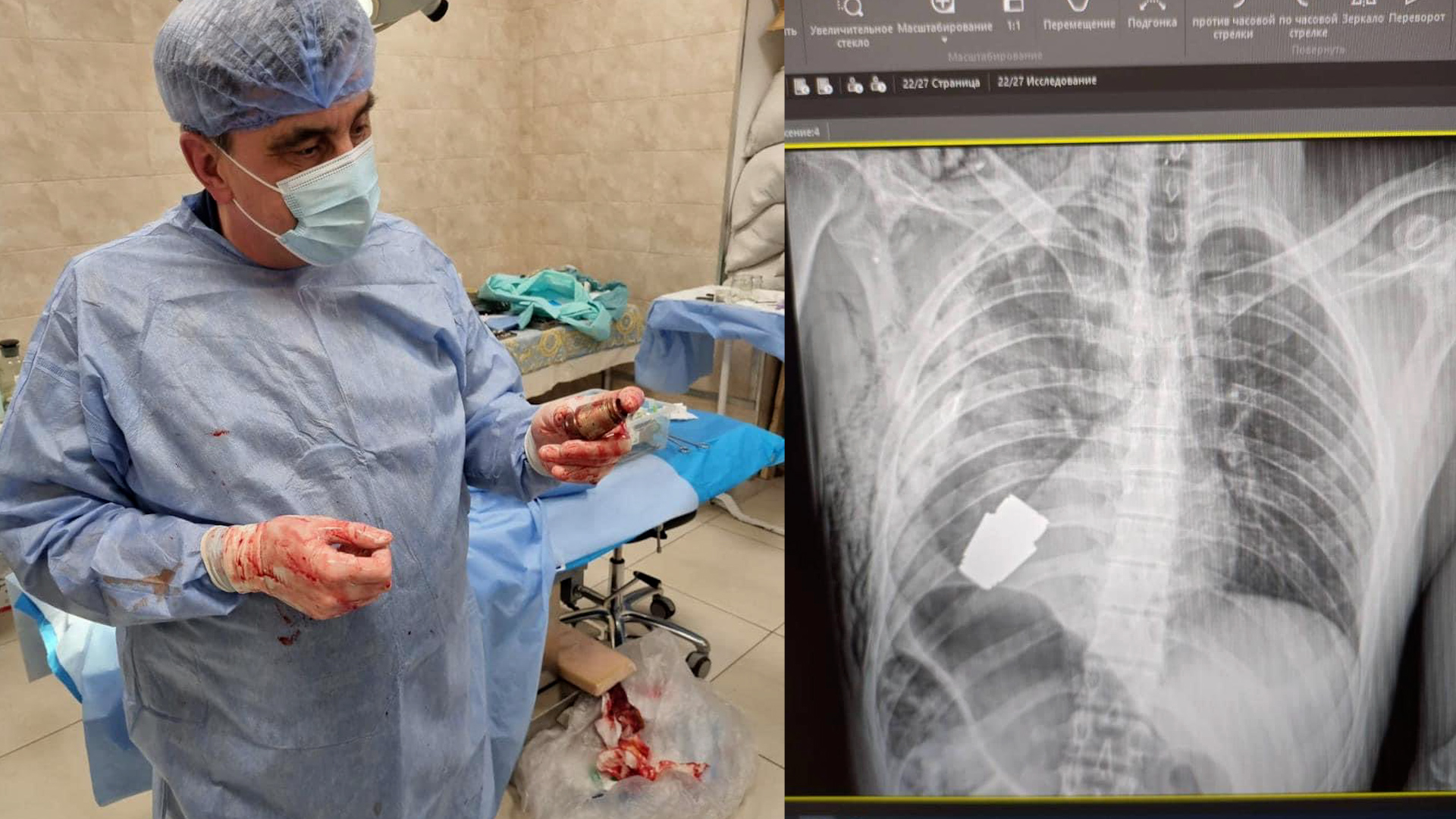 Ukrainian surgeon after removing grenade from serviceman's chest, along with xray of the grenade