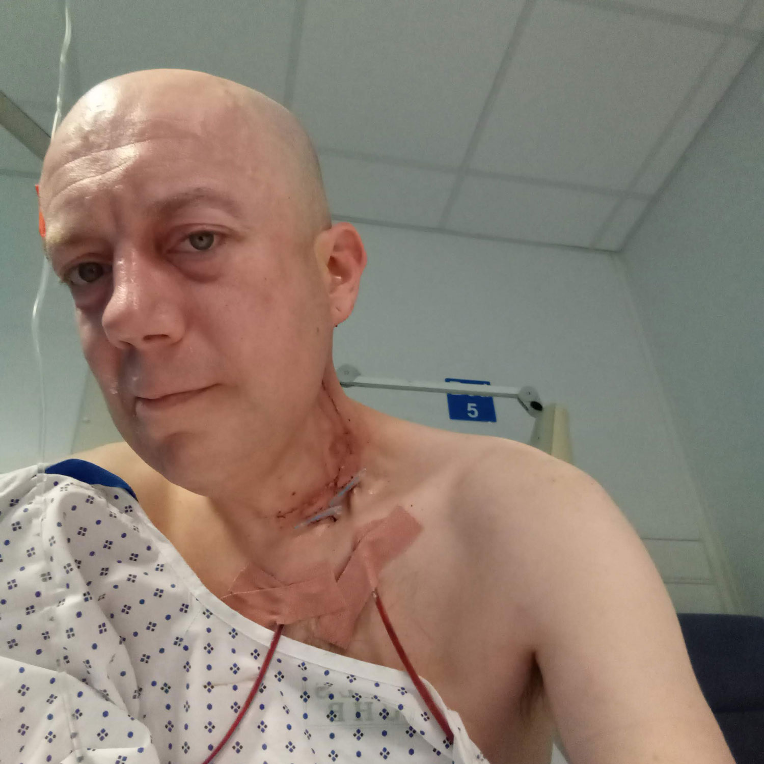 Flt Lt James Iddon After Neck Surgery After Chemotherapy Radiotherapy And A Radical Neck Dissection Credit Flt Lt James Iddon