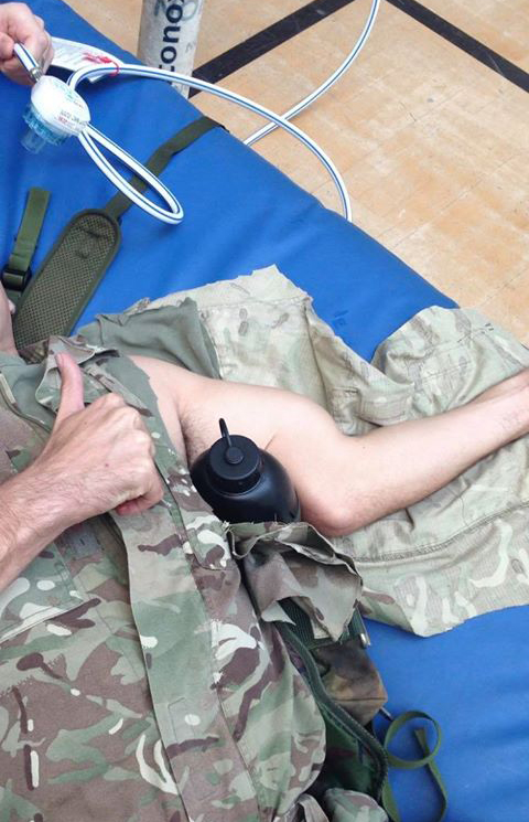 Broken arm