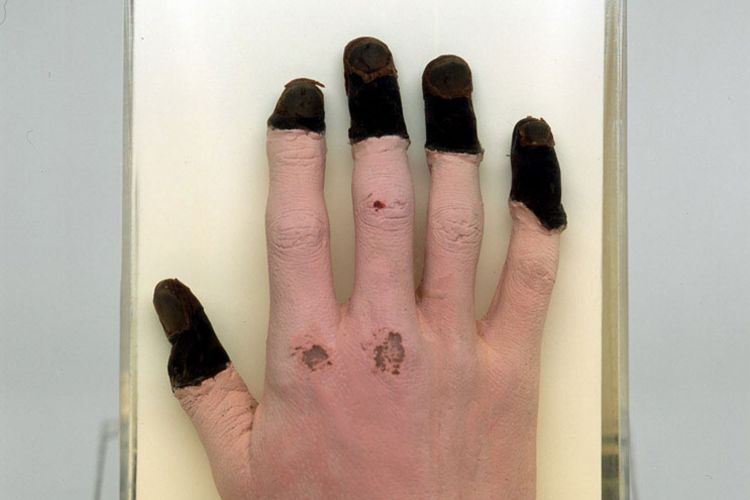 Major 'Bronco' Lane's Fingertips on display at the National Army Museum 