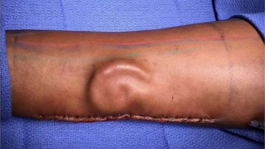 Cartilage growing in a patient’s forearm as part of a total ear reconstruction performed at William Beaumont Army Medical Center. (Credit: U.S. Army)
